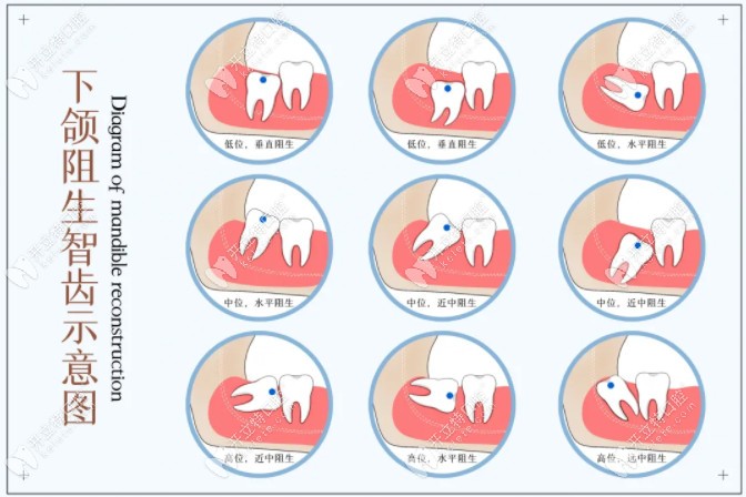 不同位置的智齿分类