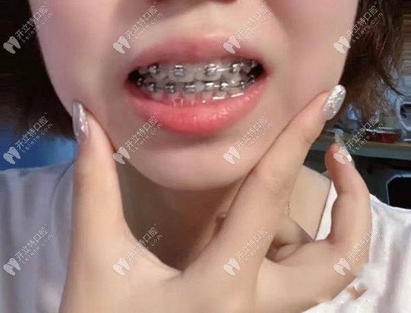 金属自锁矫正龅牙 金属自锁矫正龅牙