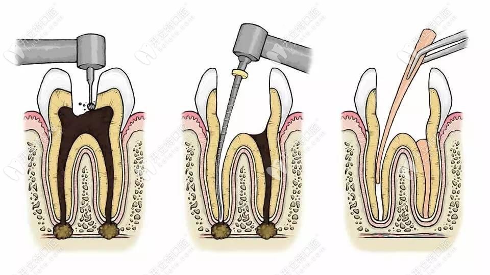根管治疗操作不当也会导致牙根纵裂