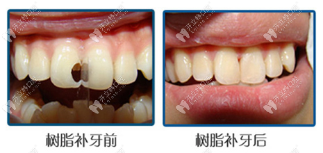 树脂补牙前后对比 树脂补牙前后对比