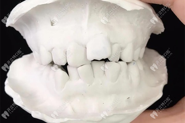 正畸前的牙齿模型