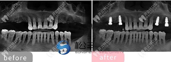 多颗牙齿缺失种植效果展示