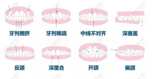 牙齿畸形的表现