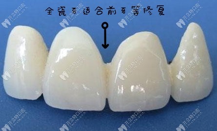 前牙等修复推荐全瓷牙 前牙等修复推荐全瓷牙