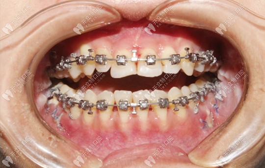 骨性反颌做完正颌手术后的牙齿照