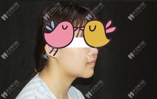 骨性地包天做正颌后的脸型改变<span style= 骨性地包天做正颌后的脸型改变<span style=
