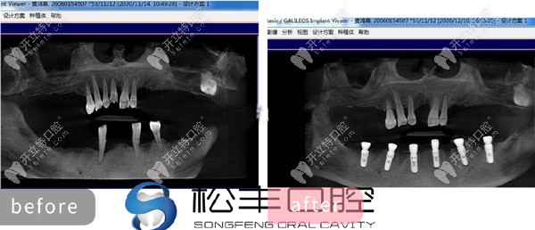 下颌即刻种植效果