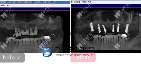 上半口做了6颗即刻负重种植牙的CT片