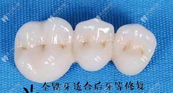 全锆牙适合做后牙等修复 全锆牙适合做后牙等修复