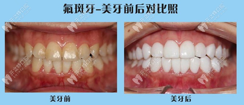 氟斑牙做完树脂美牙贴面后的效果