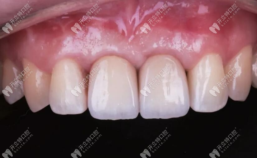 整个修复病例完成后的情况 整个修复病例完成后的情况
