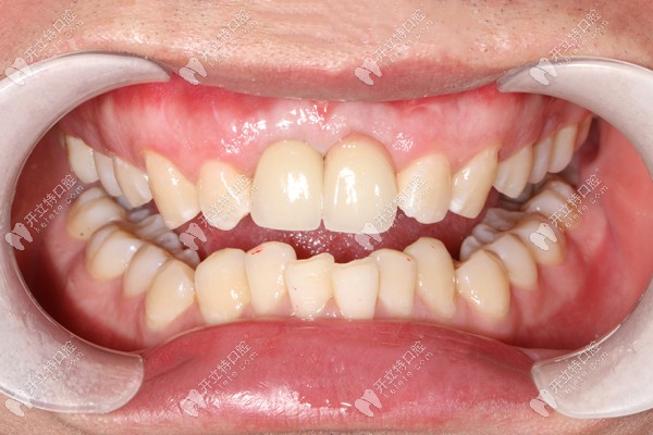 前牙美学种植修复后的效果图