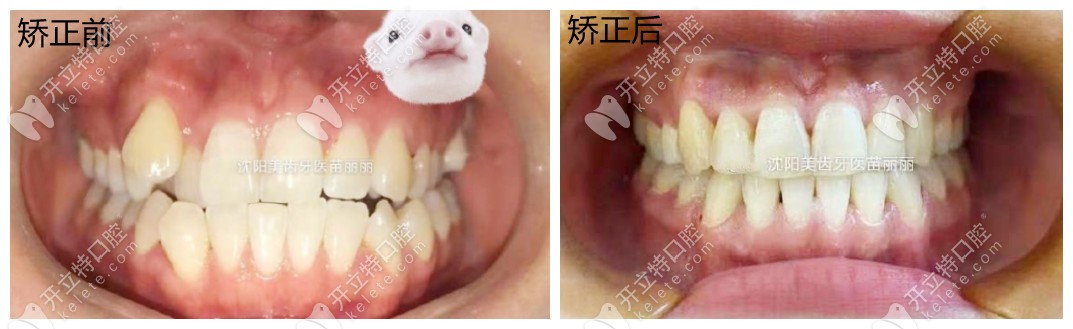 矫正前后对比图
