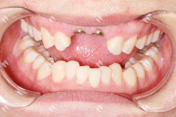 前牙种植修复过程图