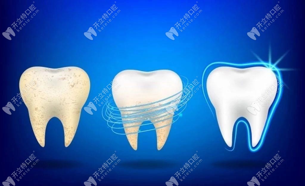 牙齿美白过程展示